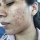 Dealing with Acne -30 Days update